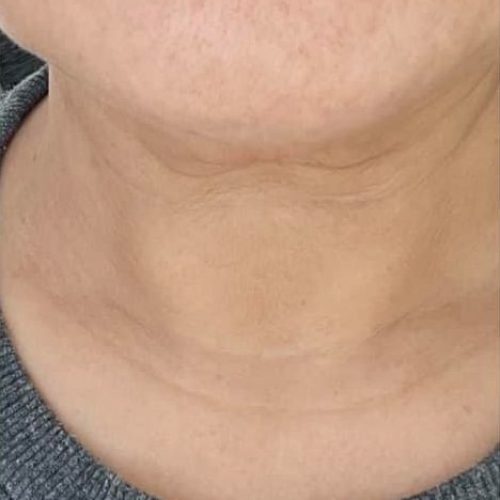 neck after cream